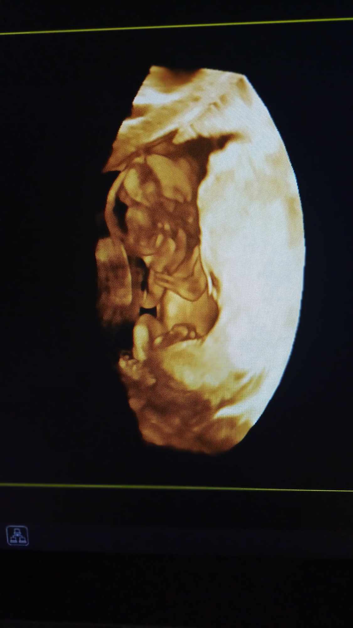 Ultrazvukové vyšetrenie tehotenstva