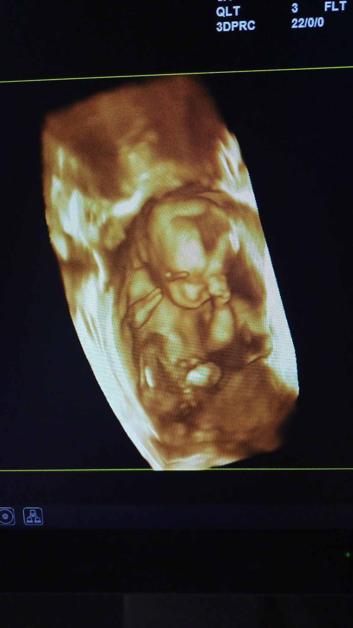 Ultrazvukové vyšetrenie tehotenstva