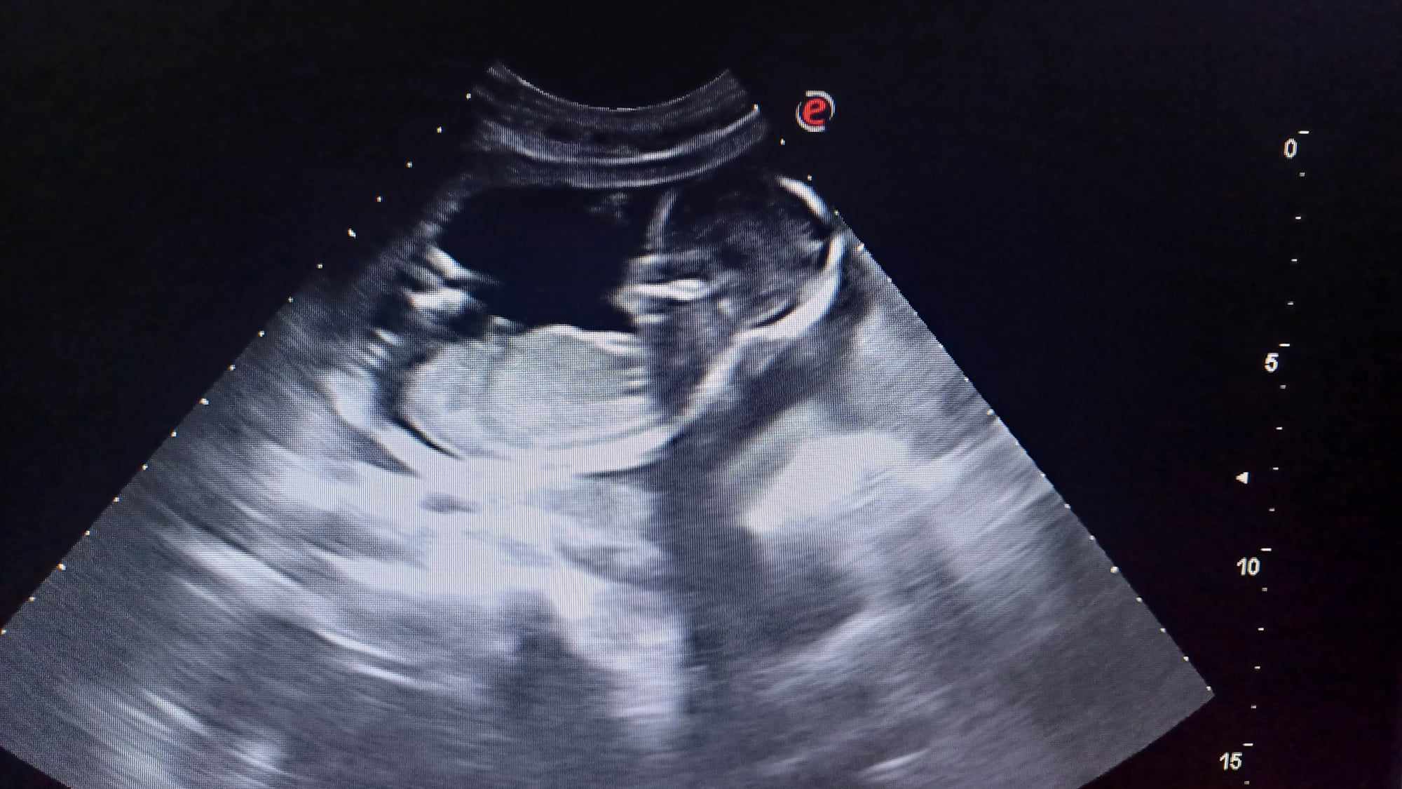 Ultrazvukové vyšetrenie tehotenstva