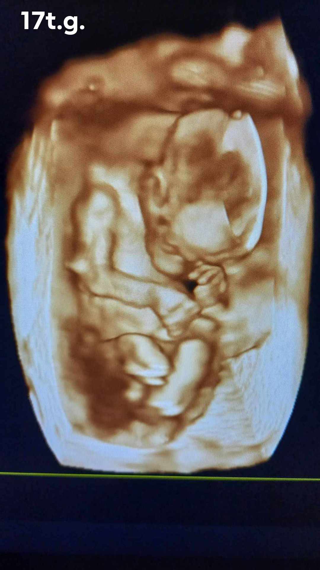 Ultrazvukové vyšetrenie tehotenstva