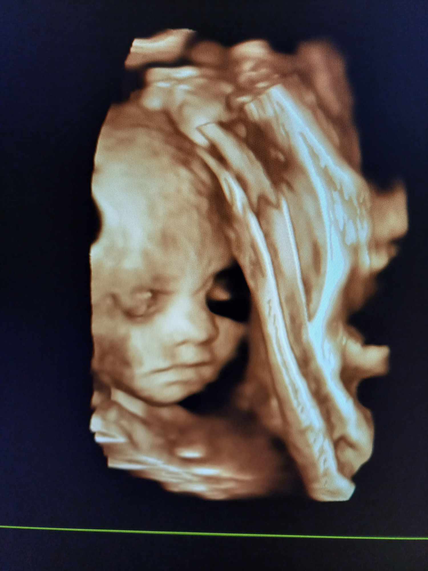 Ultrazvukové vyšetrenie tehotenstva