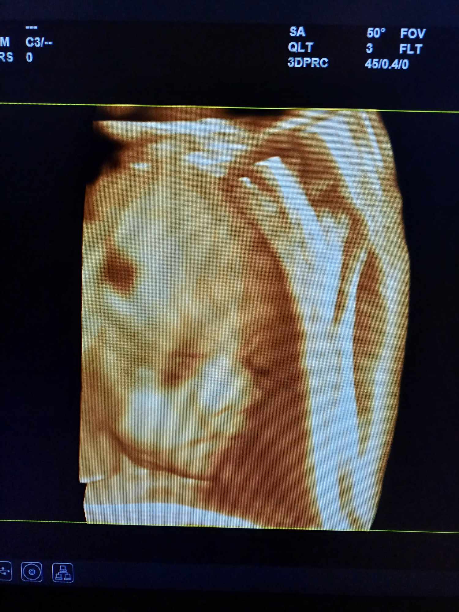 Ultrazvukové vyšetrenie tehotenstva