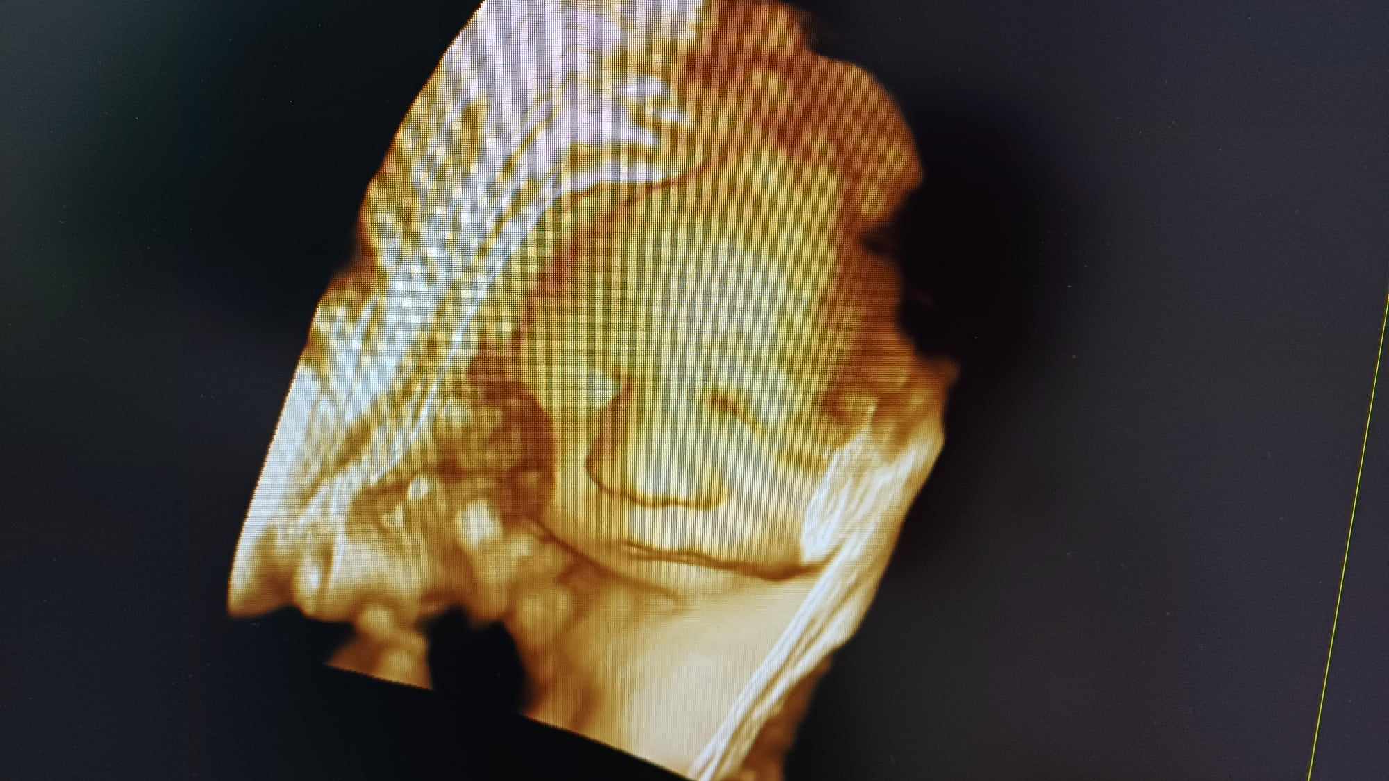 Ultrazvukové vyšetrenie tehotenstva