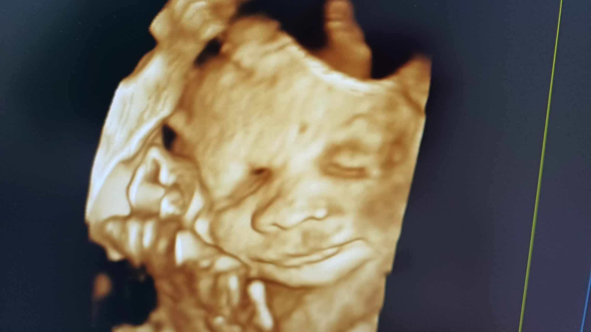 Ultrazvukové vyšetrenie tehotenstva