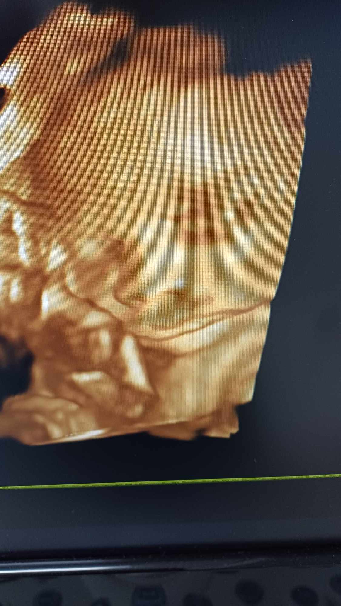 Ultrazvukové vyšetrenie tehotenstva