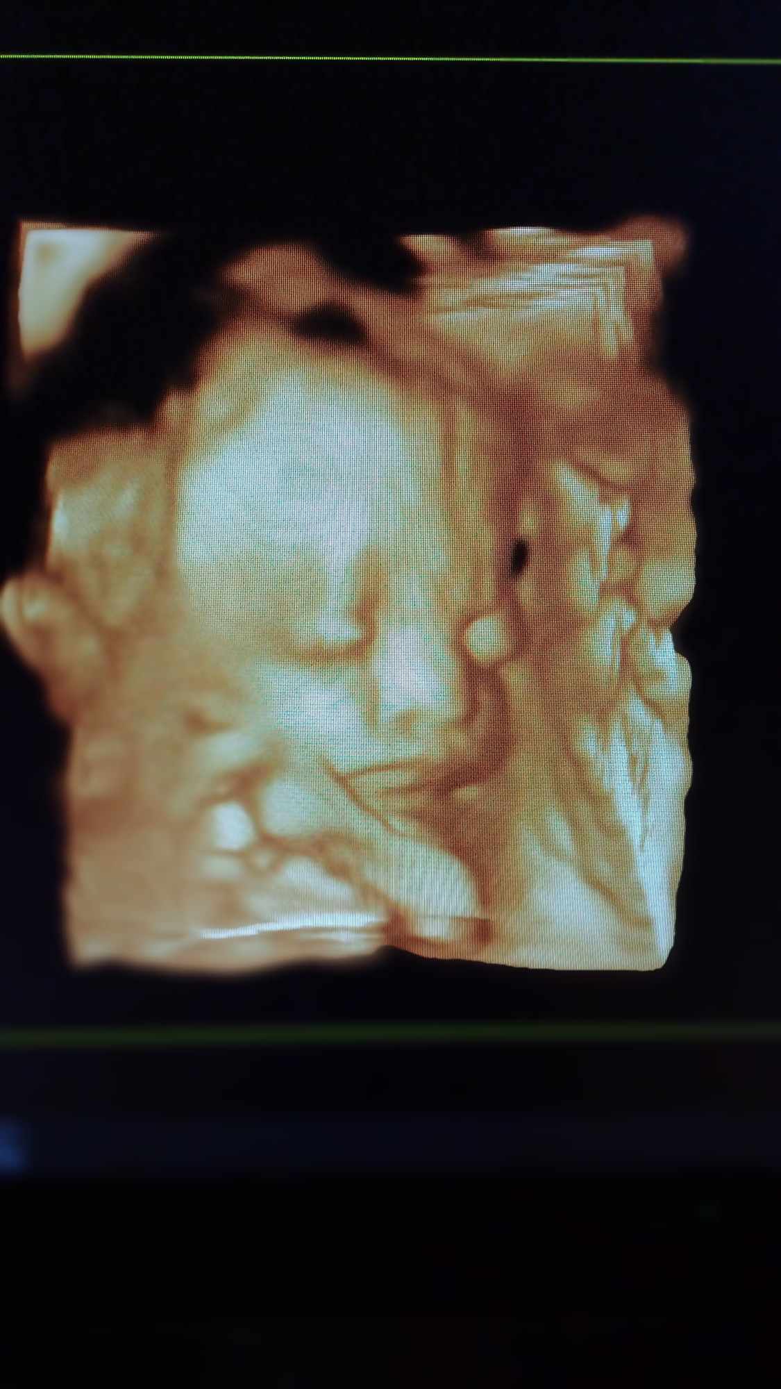 Ultrazvukové vyšetrenie tehotenstva