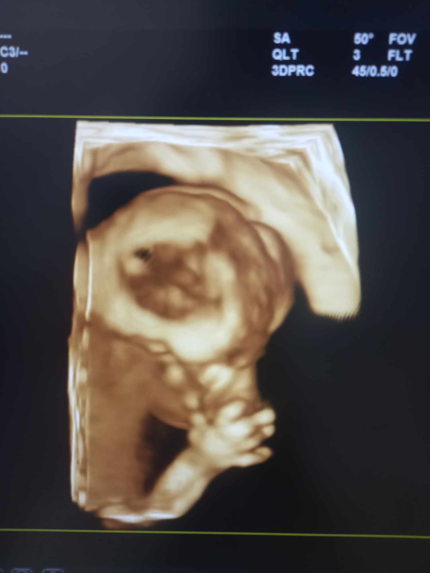 Ultrazvukové vyšetrenie tehotenstva