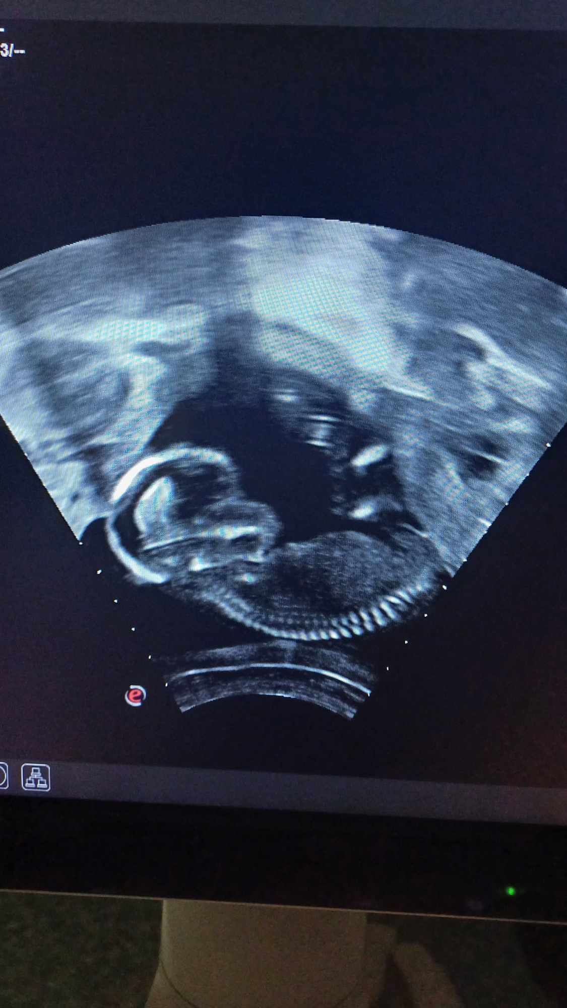 Ultrazvukové vyšetrenie tehotenstva